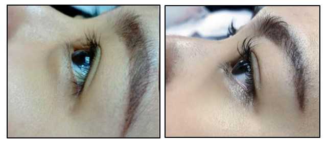 Eyelid Surgery Image
