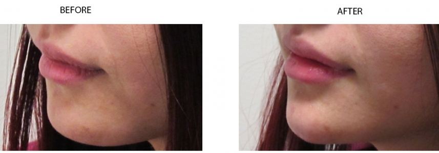 Chin Augmentation / Enhancement
