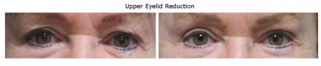 upper-eyelid-reduction