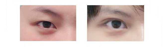 minimally invasive double eyelidplasty