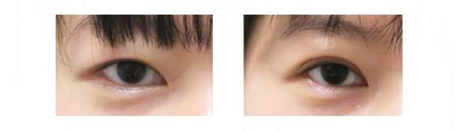 minimally invasive double eyelidplasty