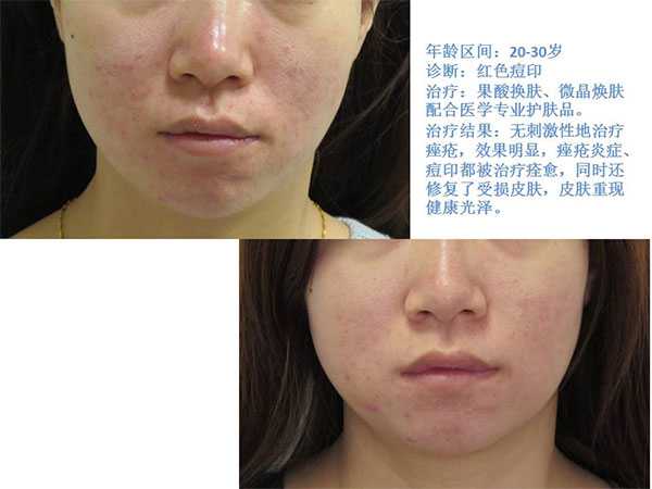 Acne and scar treatment