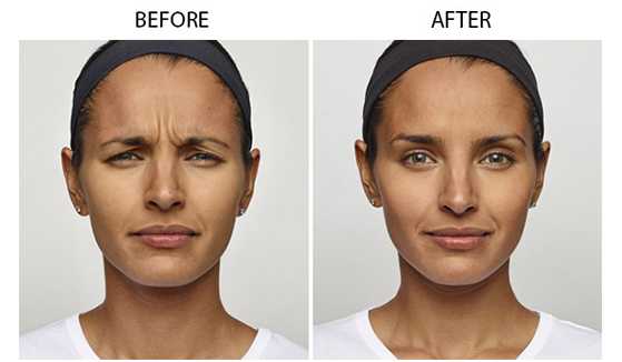 Anti-Wrinkle Reduction Melbourne  Minimally Invasive Anti-Aging Cosmetic  Procedure Melbourne