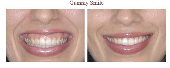 Anti Wrinkle Injections Images