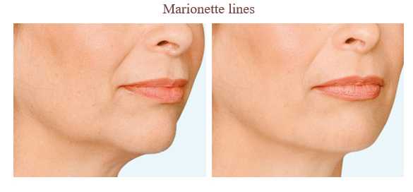 Anti Wrinkle Injections Images