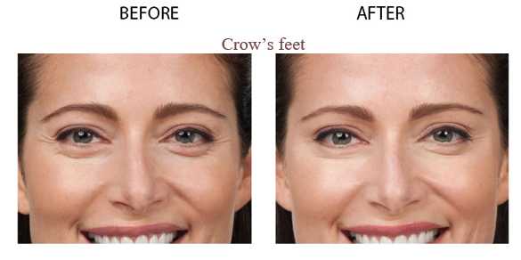 Anti Wrinkle Injections Images