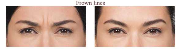 Anti Wrinkle Injections Images