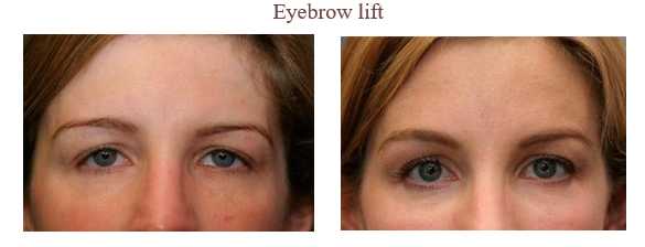 Anti Wrinkle Injections Images