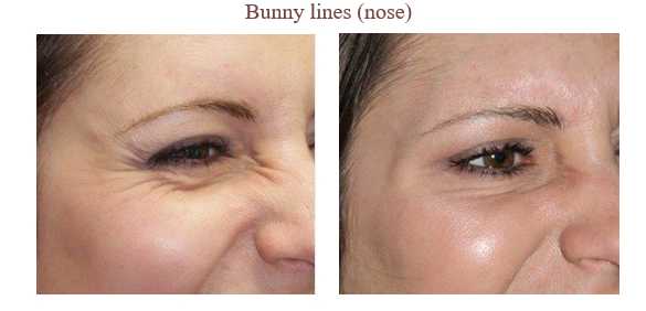 Anti Wrinkle Injections Images