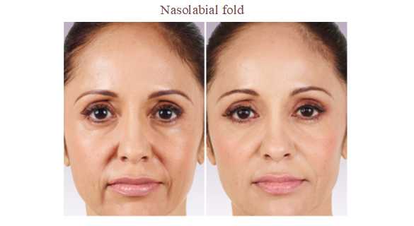 Anti Wrinkle Injections Images