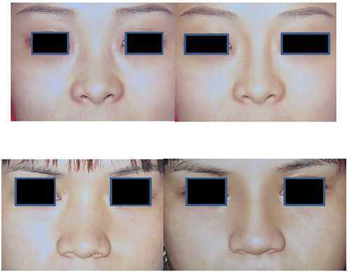 Asian Rhinoplasty