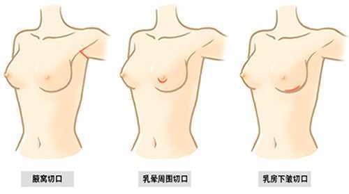 breast-augmentation