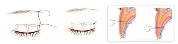 Embedding Double Eyelids