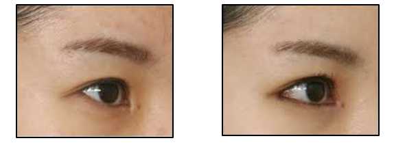 Eyelid Surgery Image