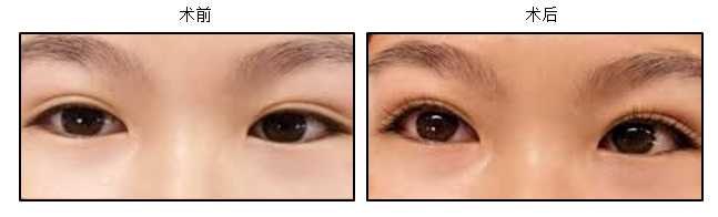 Eyelid Surgery Image