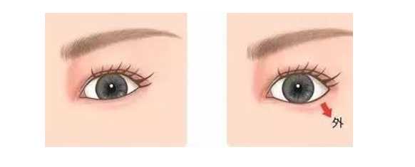 Eyelid Surgery Image