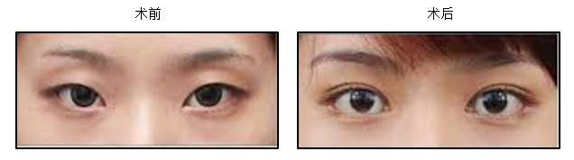 Eyelid Surgery Image