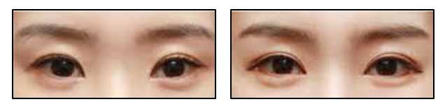 Eyelid Surgery Image