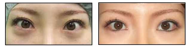 Eyelid Surgery Image