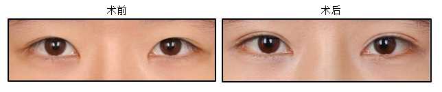 Eyelid Surgery Image