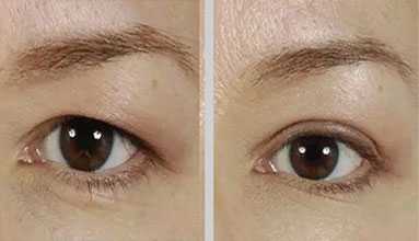 Eyelid Surgery Image