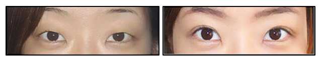 Eyelid Surgery Image