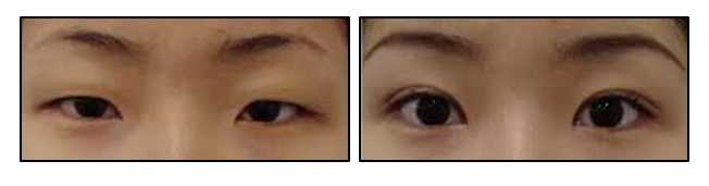 Eyelid Surgery Image