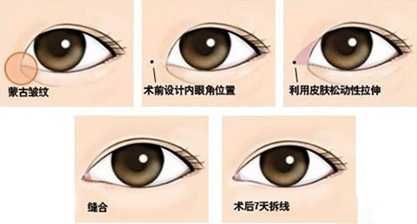 Eyelid Surgery Image