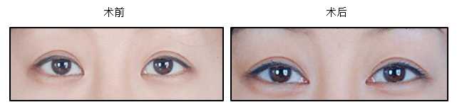 Eyelid Surgery Image