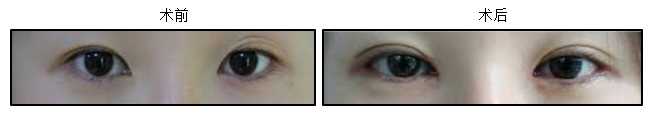 Eyelid Surgery Image