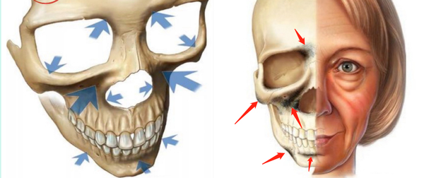 Facial contour fixation and anti-aging