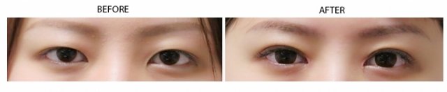 Asian Double Eyelid Surgery