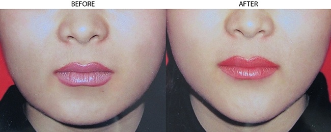 Chin Augmentation