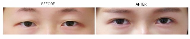 double-eyelid-surgery