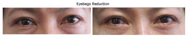 eyebags-reduction