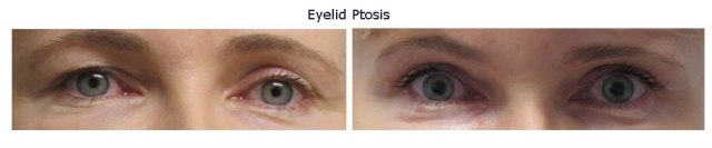 eyelid-ptosis