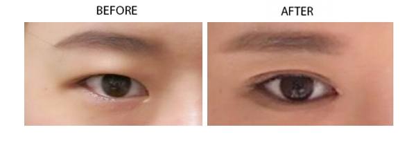 invasive-scarless-double-eyelid