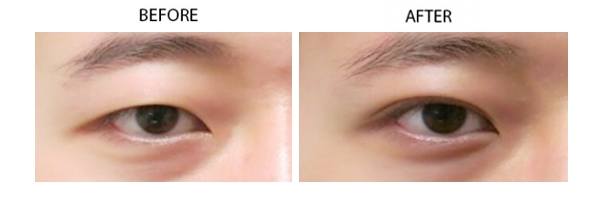 korean-seamless-eyelid