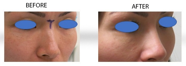 rhinoplasty-media