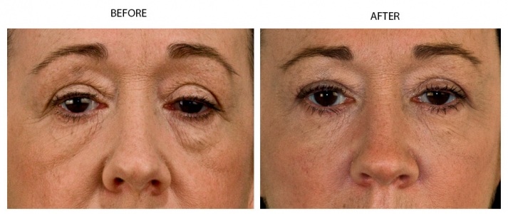 Tear Troughs Treatment