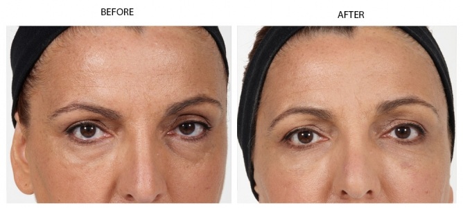 Tear Troughs Treatment