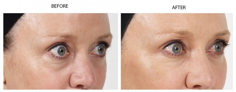 Tear Troughs Treatment