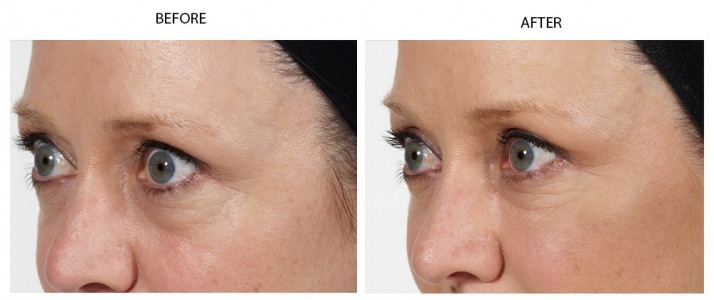 Tear Troughs Treatment