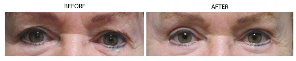 upper-eyelid-reduction
