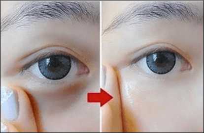 Minimally invasive eye bags and dark circles