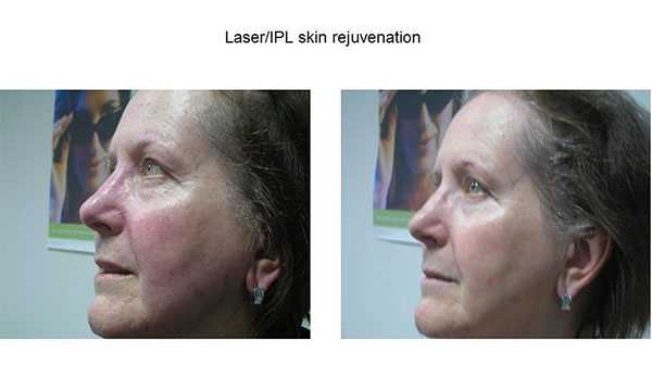 IPL Photorejuvenation Image