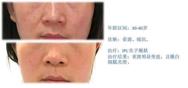 IPL Photorejuvenation Image