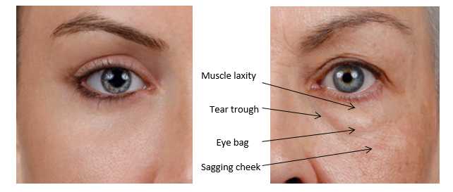 Lower Eyelid Rejuvenation Image