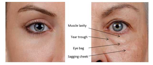 How Can I Remove My Eye Bags  London Premier Laser  Skin Clinic