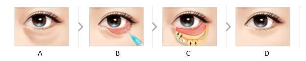 Lower Eyelid Rejuvenation Image